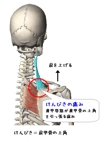 図解（けんびきの痛み）