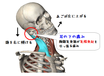 図解（耳の下の痛み）