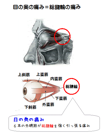 目の奥の痛み（図解）