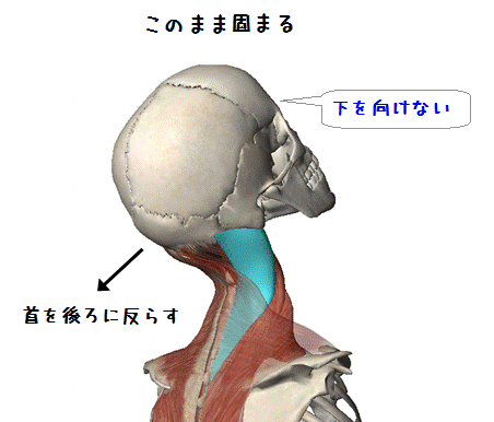 図解(下を向くと首の後ろの痛み)