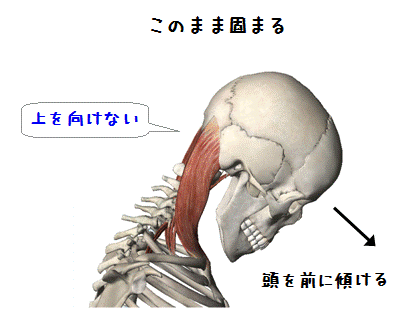 図解(上を向くと首の後ろの痛み)