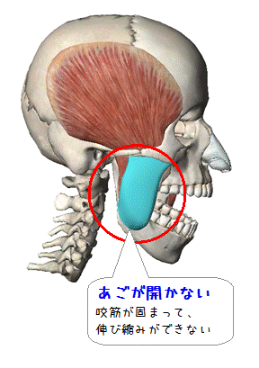 図解（咬筋あごが開かない）