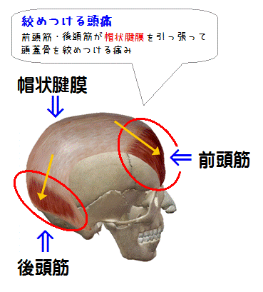 図解(絞めつける頭痛)