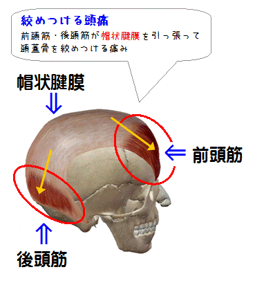 絞めつける頭痛（図解）