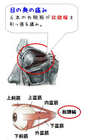 図解（目の奥の痛み）