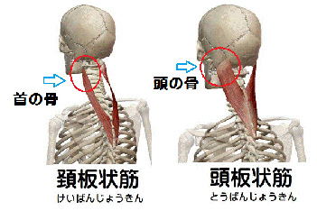 頚板状筋・頭板状筋首の後ろの痛み